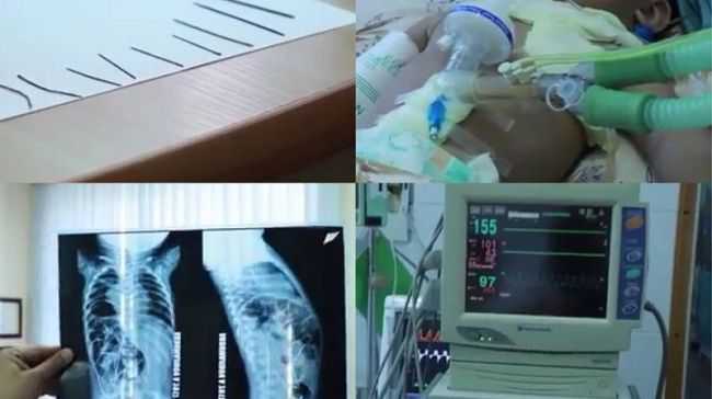 В больнице опровергли слухи о смерти младенца, в теле которого было 16 иголок