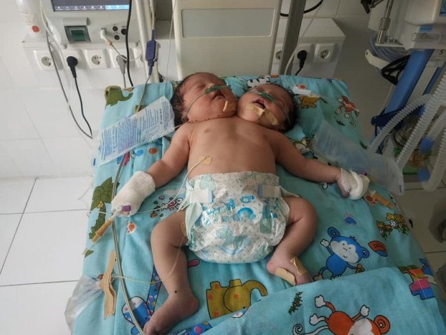 «Нарушения в экологии могут вызвать рождение сиамских близнецов», — врач о новорожденных девочках из Самаркандской области