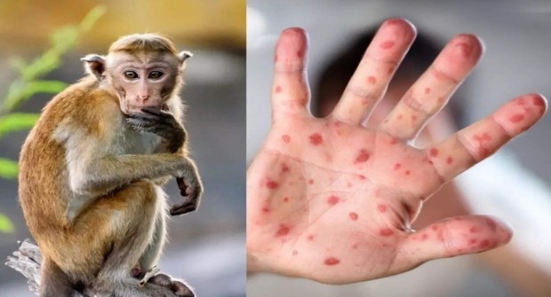 ВОЗ планирует завершить пандемию оспы обезьян