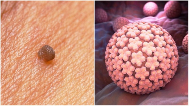 Более 30% мужчин в мире заражены ВПЧ